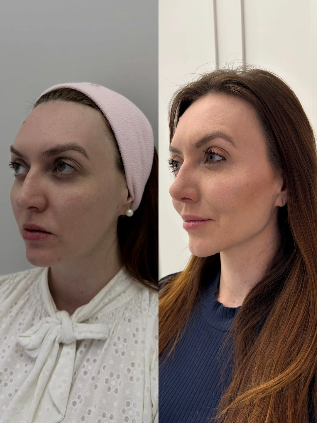 Resultado real 1 de planejamento facial individualizado