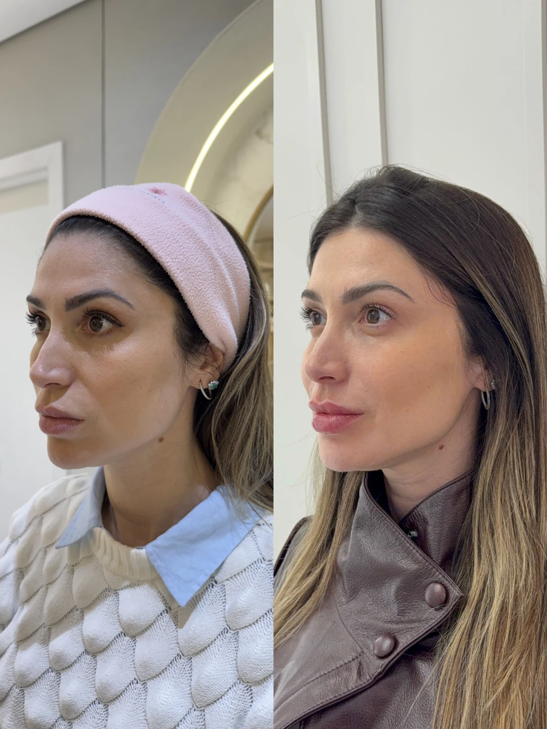 Resultado real 2 de planejamento facial individualizado