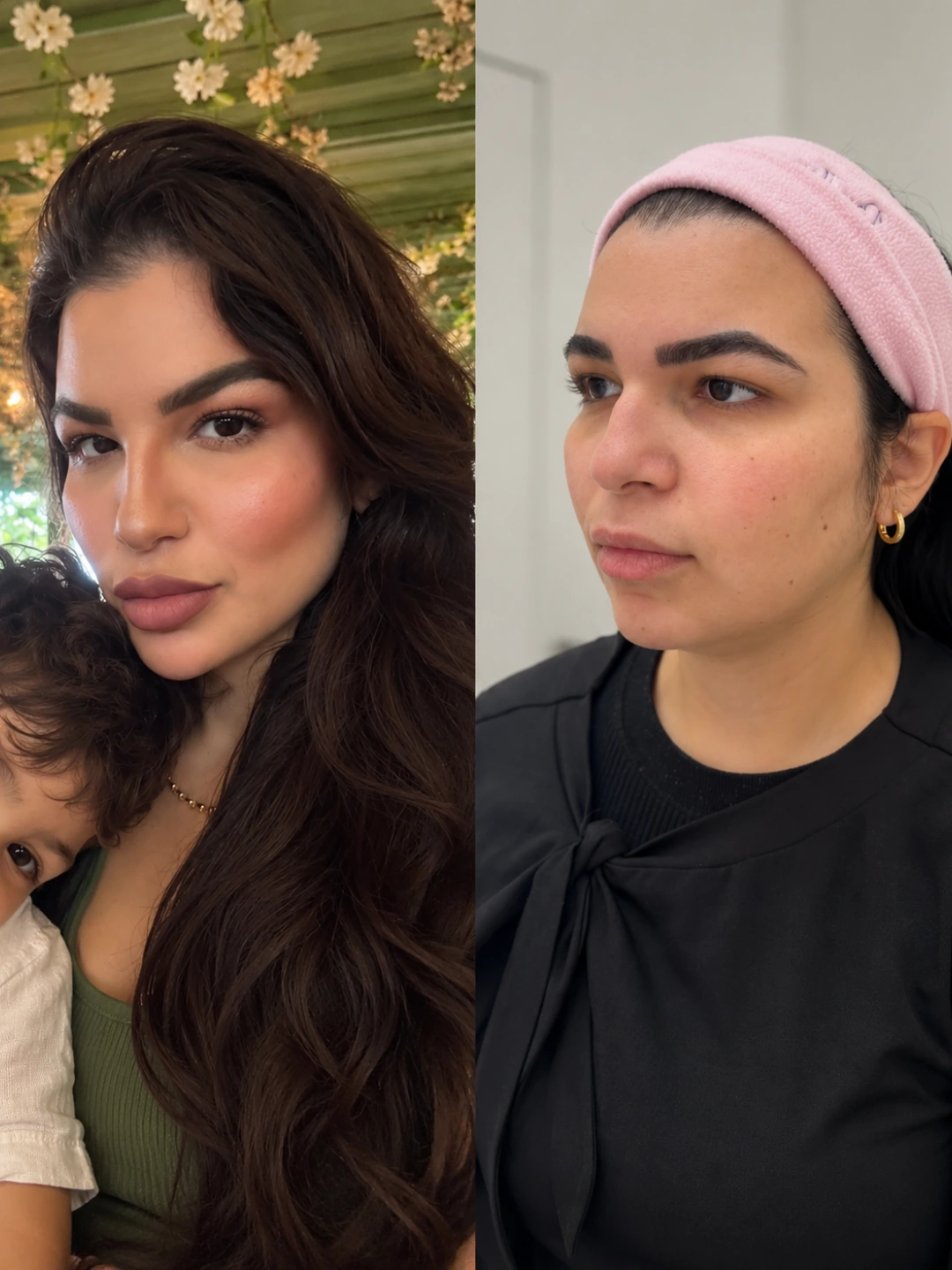 Resultado real 3 de planejamento facial individualizado