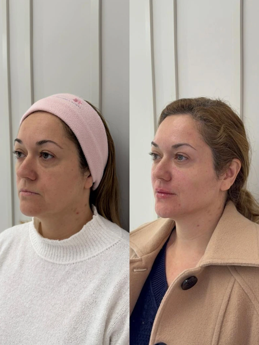 Resultado real 4 de planejamento facial individualizado